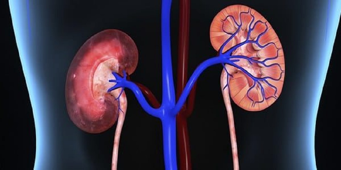 أقوى مشروب لتفتيت حصوات الكلى والتخلص من الأملاح في يومين .. تعرف عليه