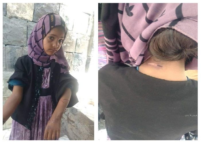 طفلة يمنية تتعرض للتعذيب الوحشي على يد زوجة والدها 