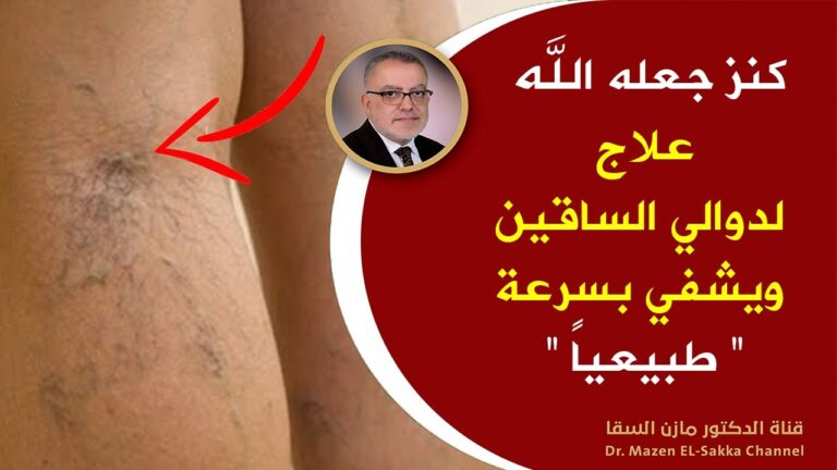 بسرعة فائقة.. کنز جعله الله علاج لدوالي الساقين ويشفي بدون اي ألم!