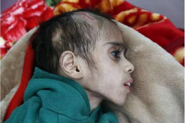 طفل يعاني من سوء التغذية في اليمن