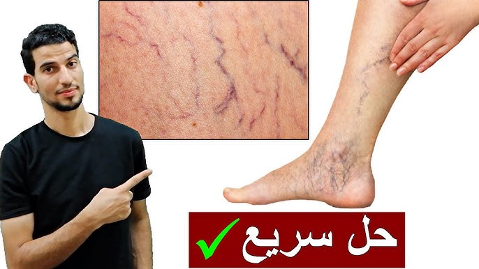 حل وعلاج سحري وطبيعي للتخلص من الدوالي .. اصنعيه الان في المنزل !