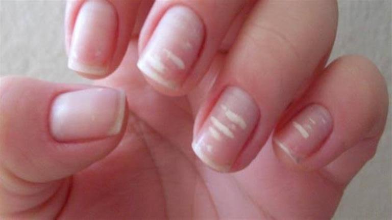 وجود هذه العلامات على اظافرك دليل على إصابتك بأمراض خطيرة!..تعرف عليها لسلامتك