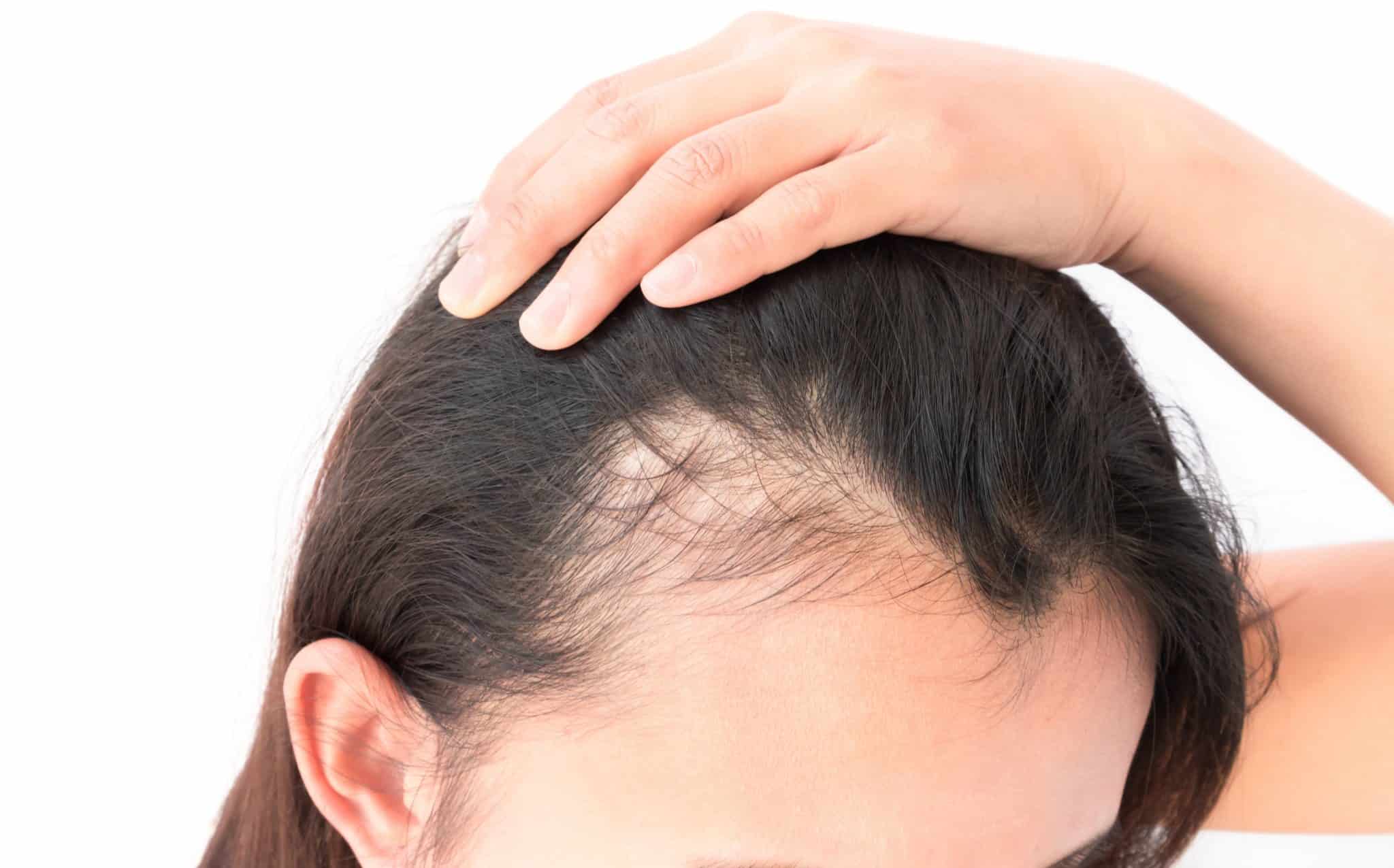 علاج تساقط الشعر