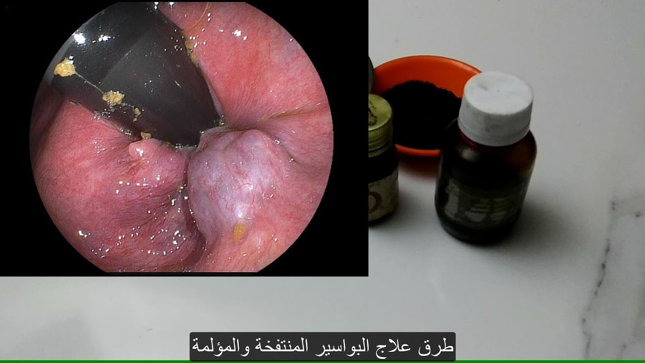 علاج البواسير