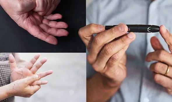 احذر ولا تتجاهلها..  هذه العلامات الثلاث اذا ظهرت في اليدين تدل على ارتفاع نسبة السكر في الدم وتلف في الأعصاب .. ( تعرف عليها )
