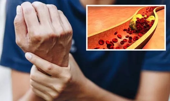 ظهور هذه العلامة في اليدين اوالقدمين تدل على ارتفاع نسبة الكوليسترول بشكل خطير في الدم .. وهذا ما يجب عليك فعله اولا !