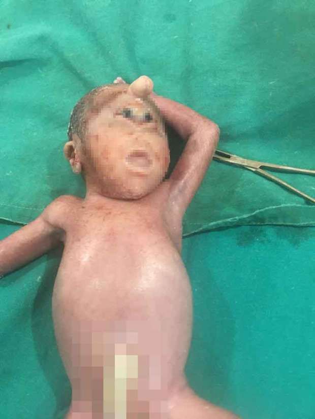 طفل بعين واحدة