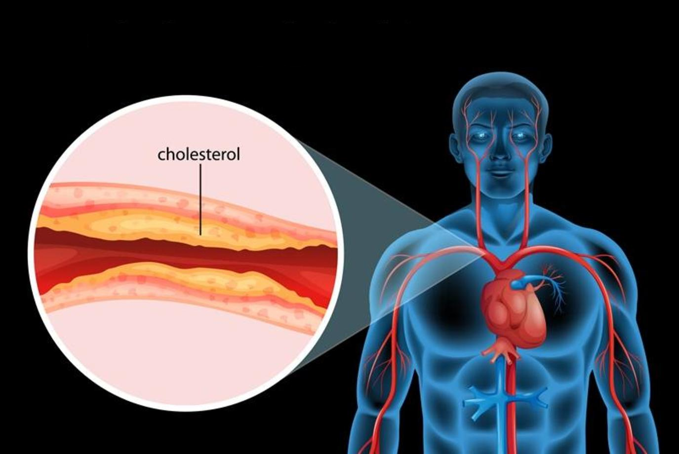 إنتبه وبشده .. علامة خفية تنذر بارتفاع الكوليسترول لا تشعر به وليس له أعراض .. ( تعرف عليها فوراً ) 